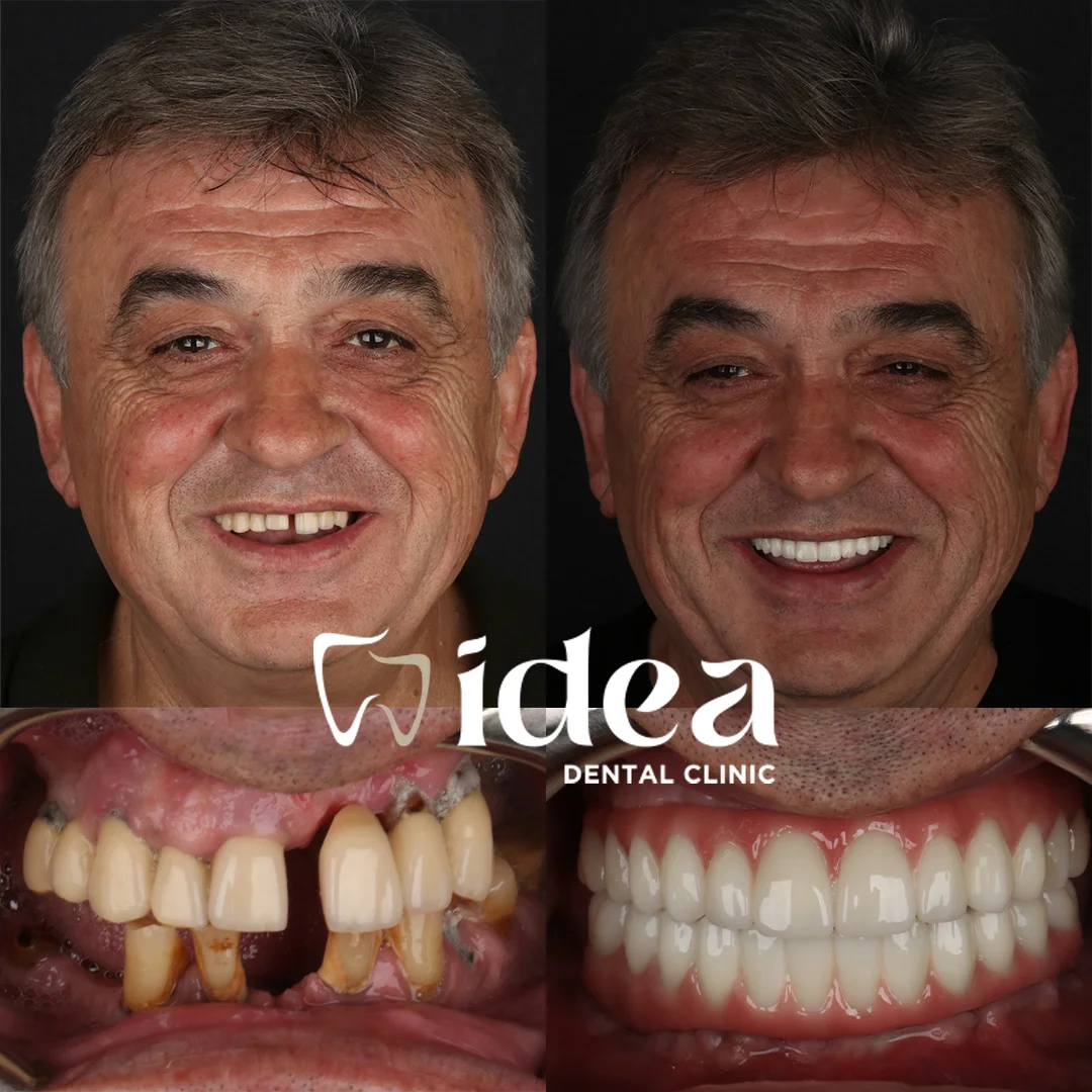 Before & After 1