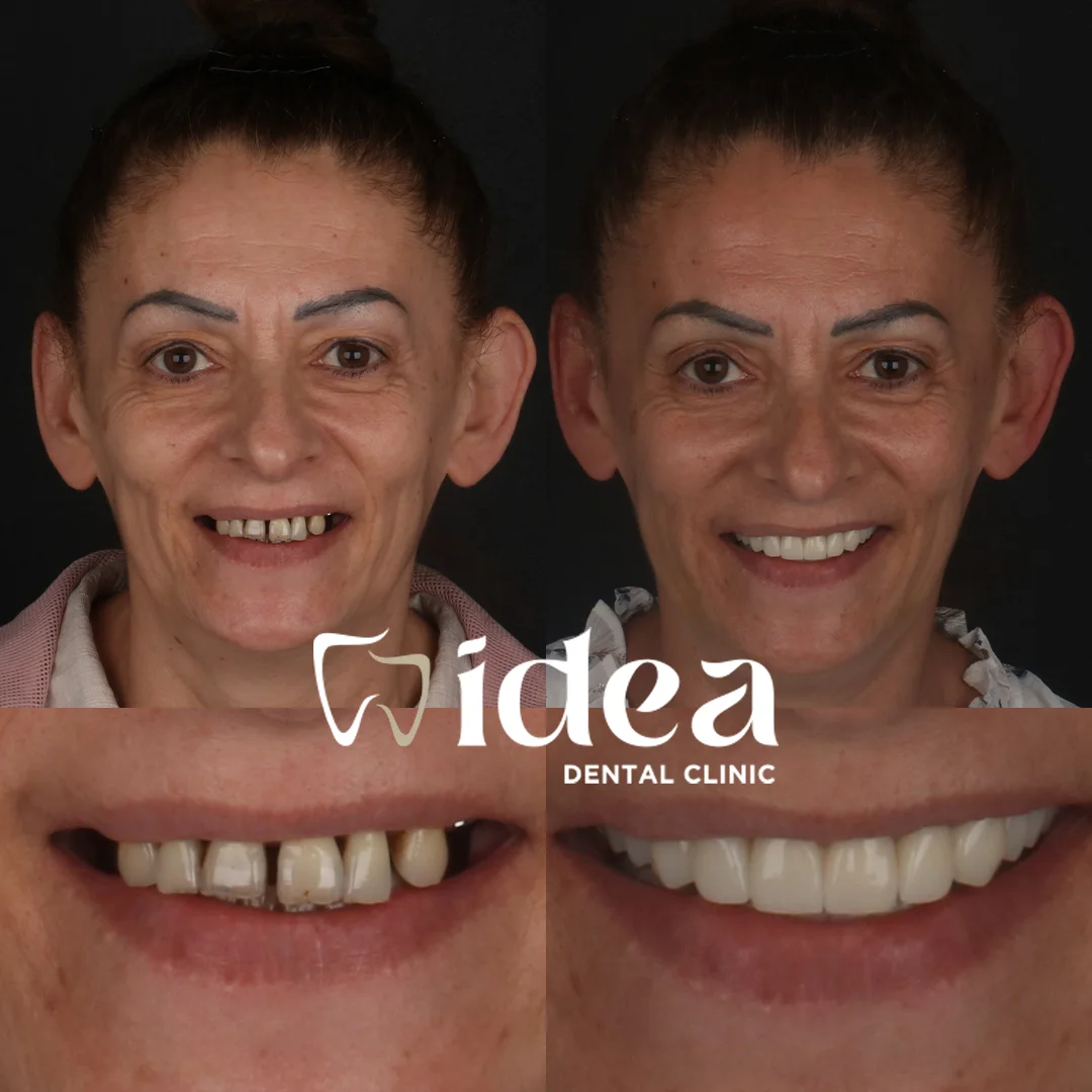 Before & After 10