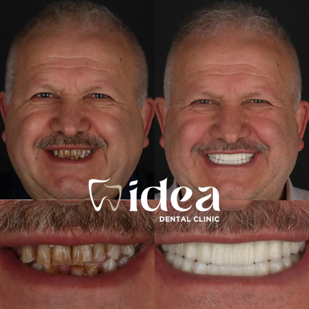 Before & After 11