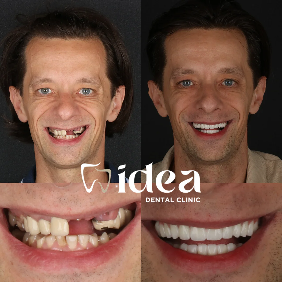 Before & After 12
