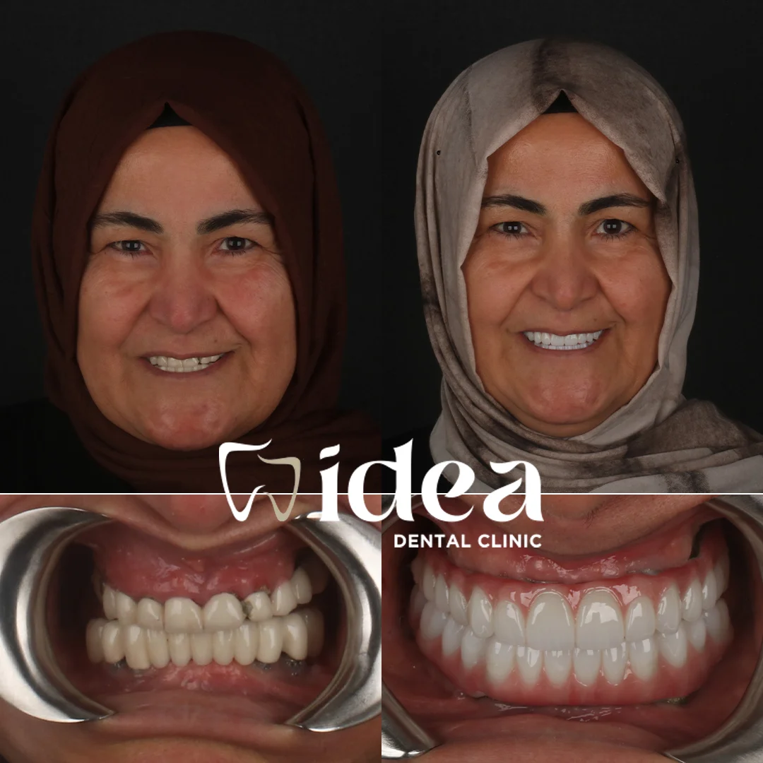 Before & After 2