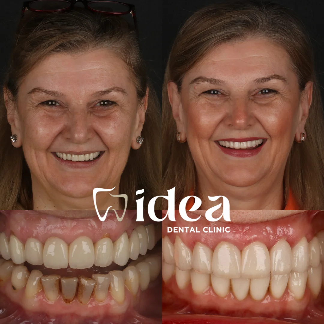 Before & After 4