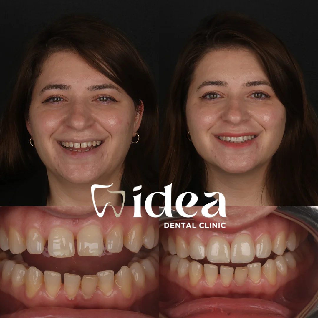 Before & After 5