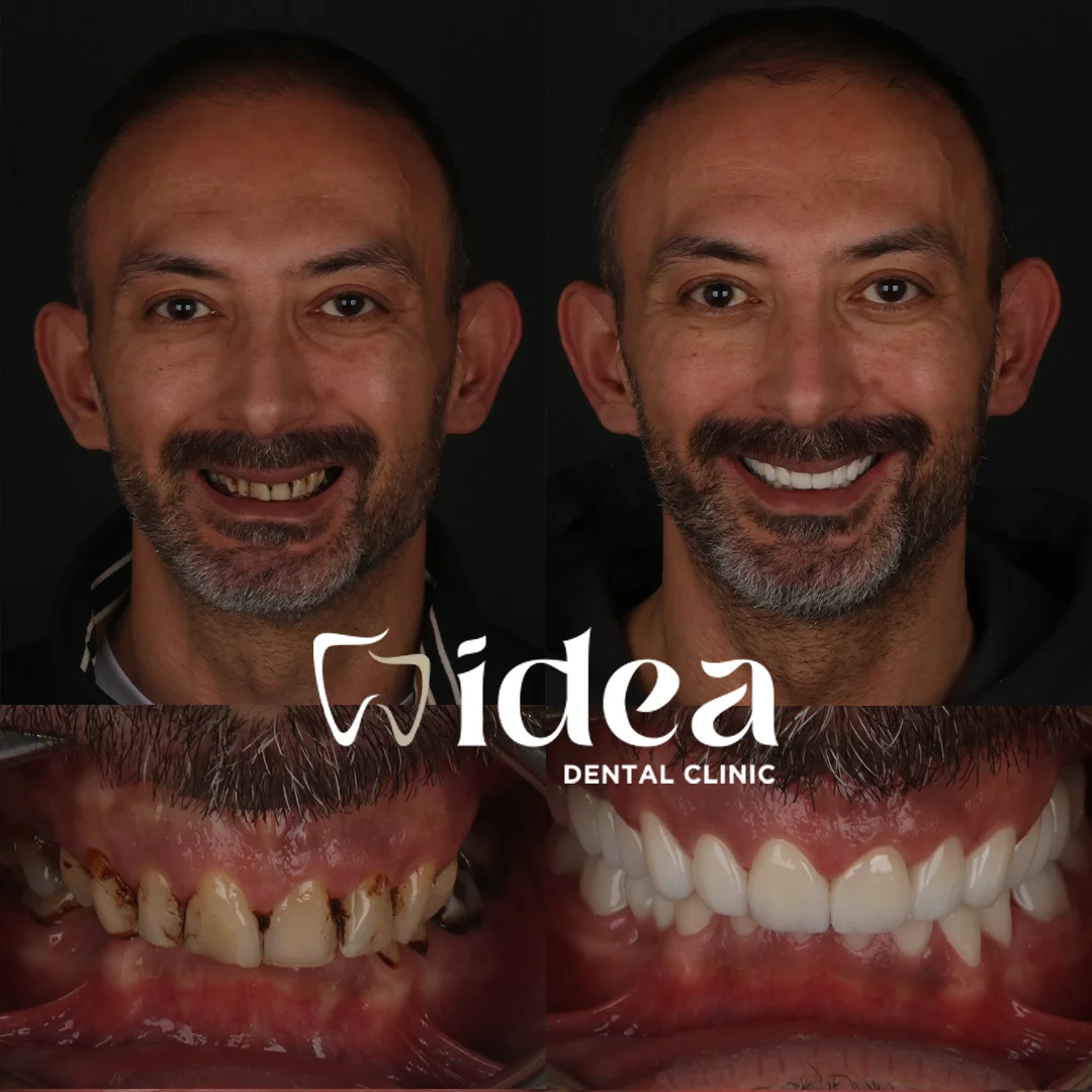 Before & After 6