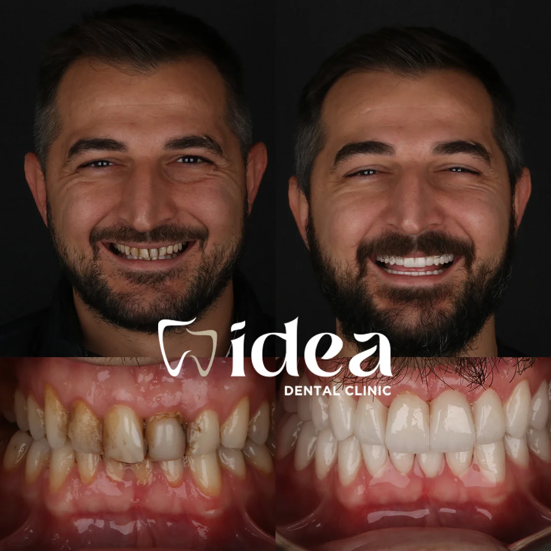 Before & After 9