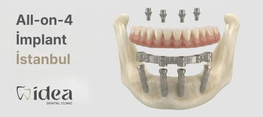 All on Four / 4 İstanbul, All on Four / 4 Fiyatları | İdea Dental Clinic