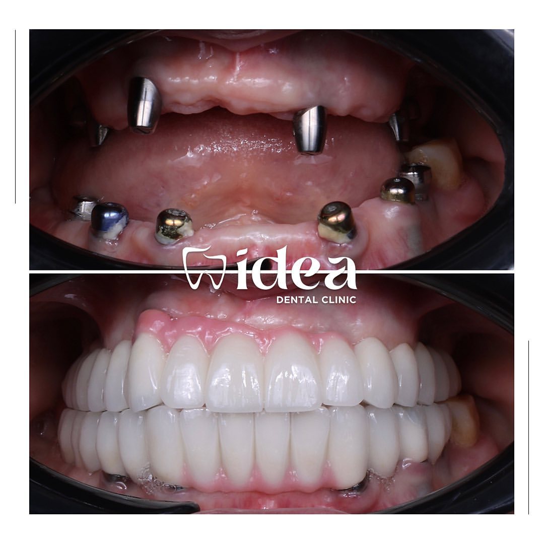 Porównanie przed leczeniem i po nim: All-on-4 w szczęce i All-on-6 w żuchwie u pacjenta Idea Dental Clinic