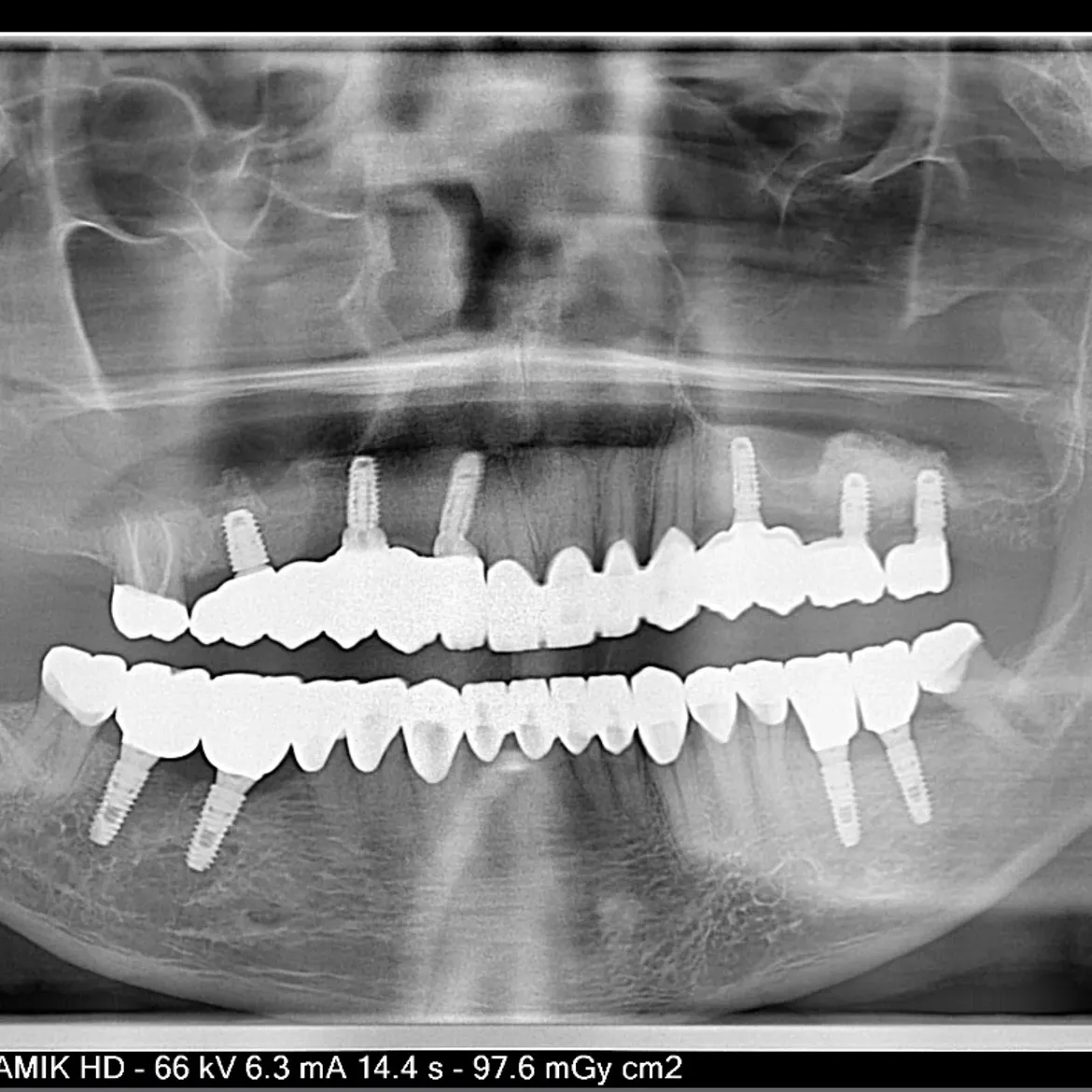 Zdjęcia panoramiczne pacjenta z sześcioma implantami pod most całego łuku w szczęce (All-on-6) i czterema implantami w żuchwie (All-on-4) w Idea Dental Clinic