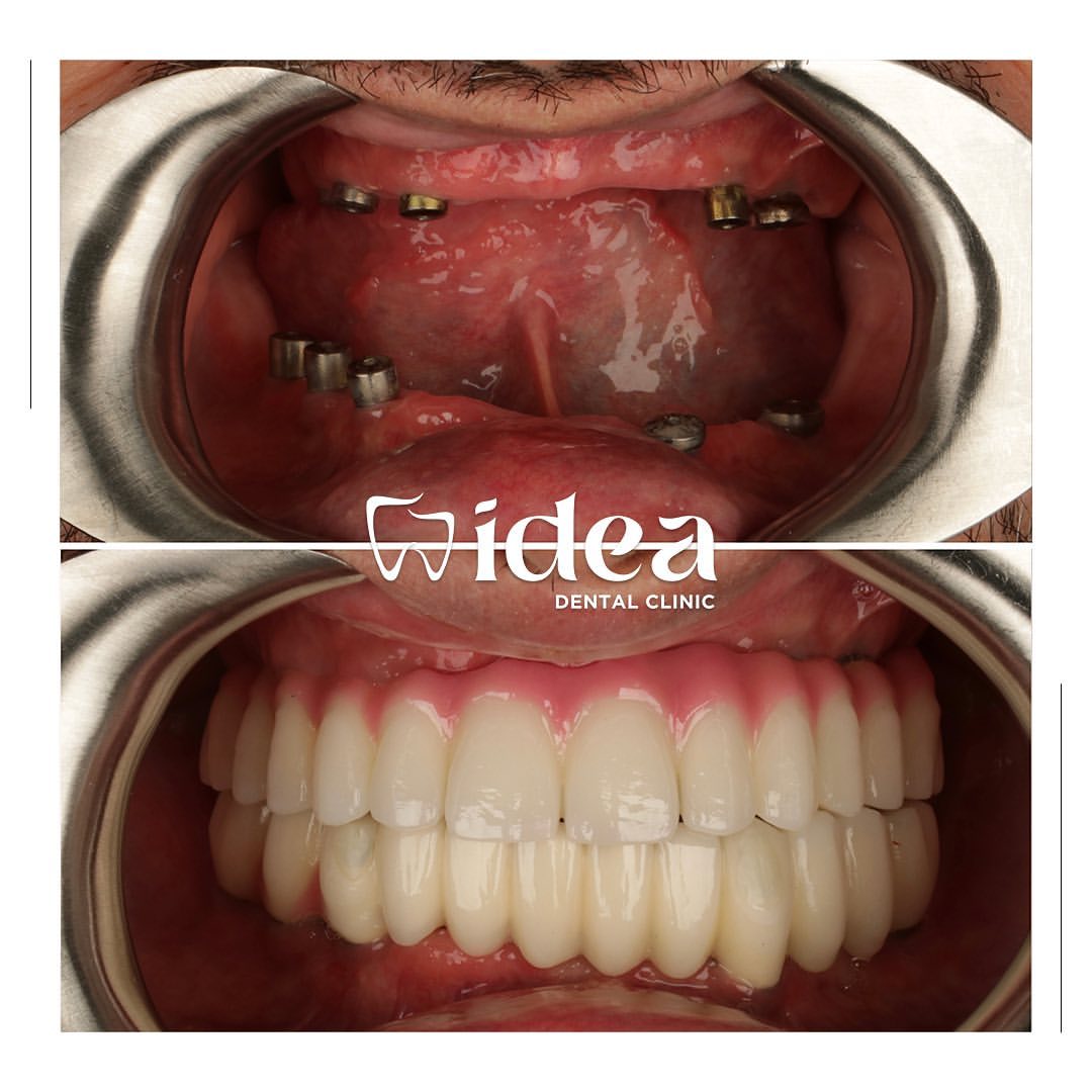 Porównanie przed i po: łączniki implantów w szczęce i żuchwie oraz stałe mosty całego łuku wykonane w Idea Dental Clinic w Stambule