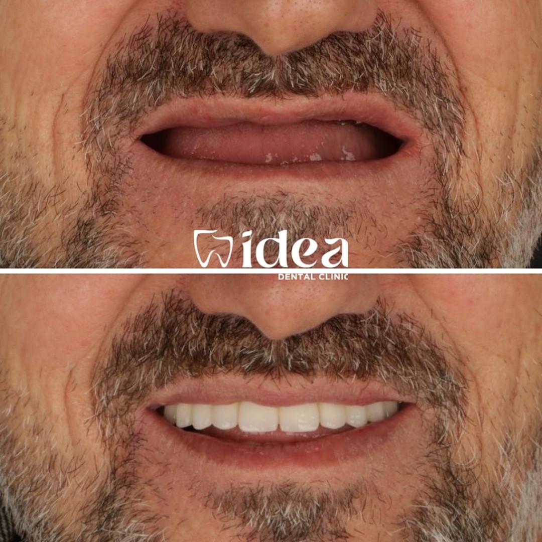 Uśmiech pacjenta z bezzębiem przed leczeniem i po założeniu stałego mostu całego łuku na implantach w Idea Dental Clinic w Stambule