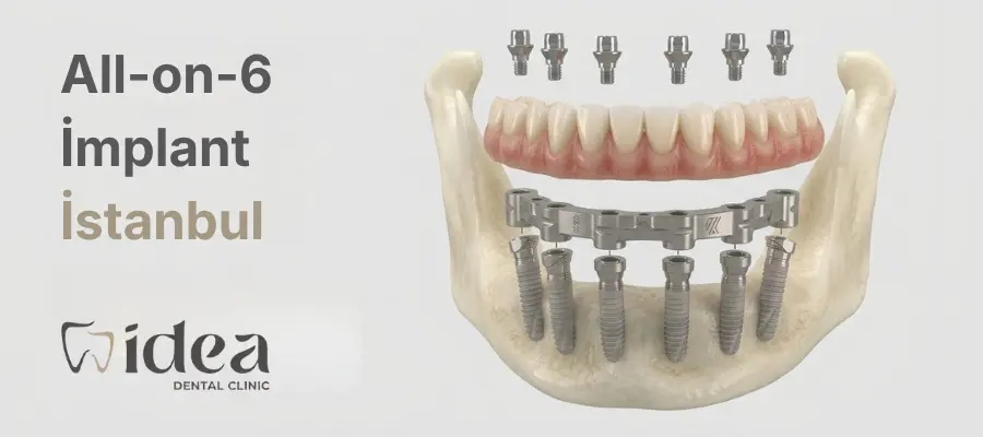 All on Six / 6 İstanbul, All on Six / 6 Fiyatları | İdea Dental Clinic
