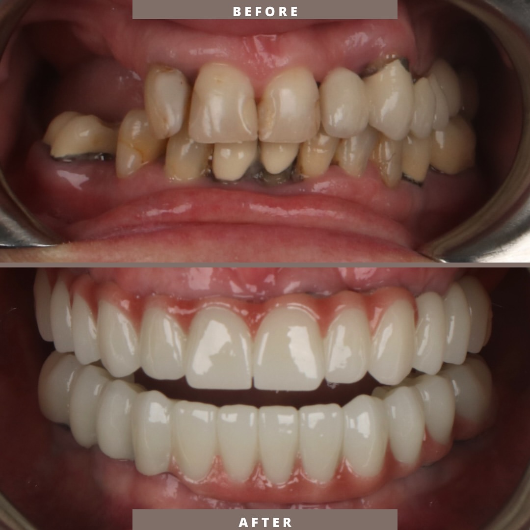 Before-and-after comparison of a second patient's teeth following implant-supported dental treatment