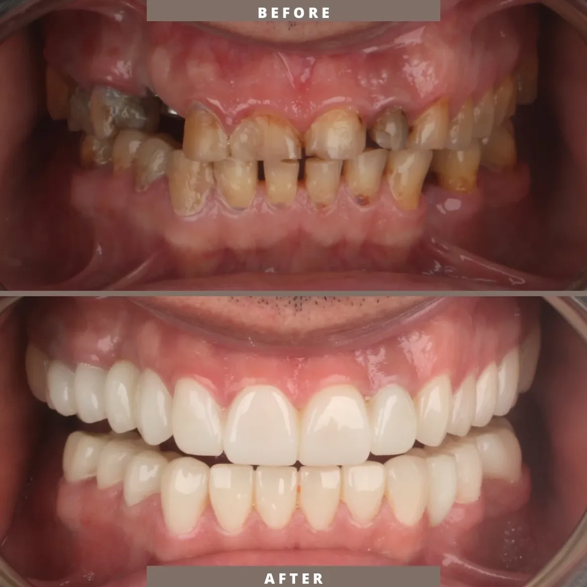 Before-and-after comparison of a patient's teeth following implant-supported dental treatment
