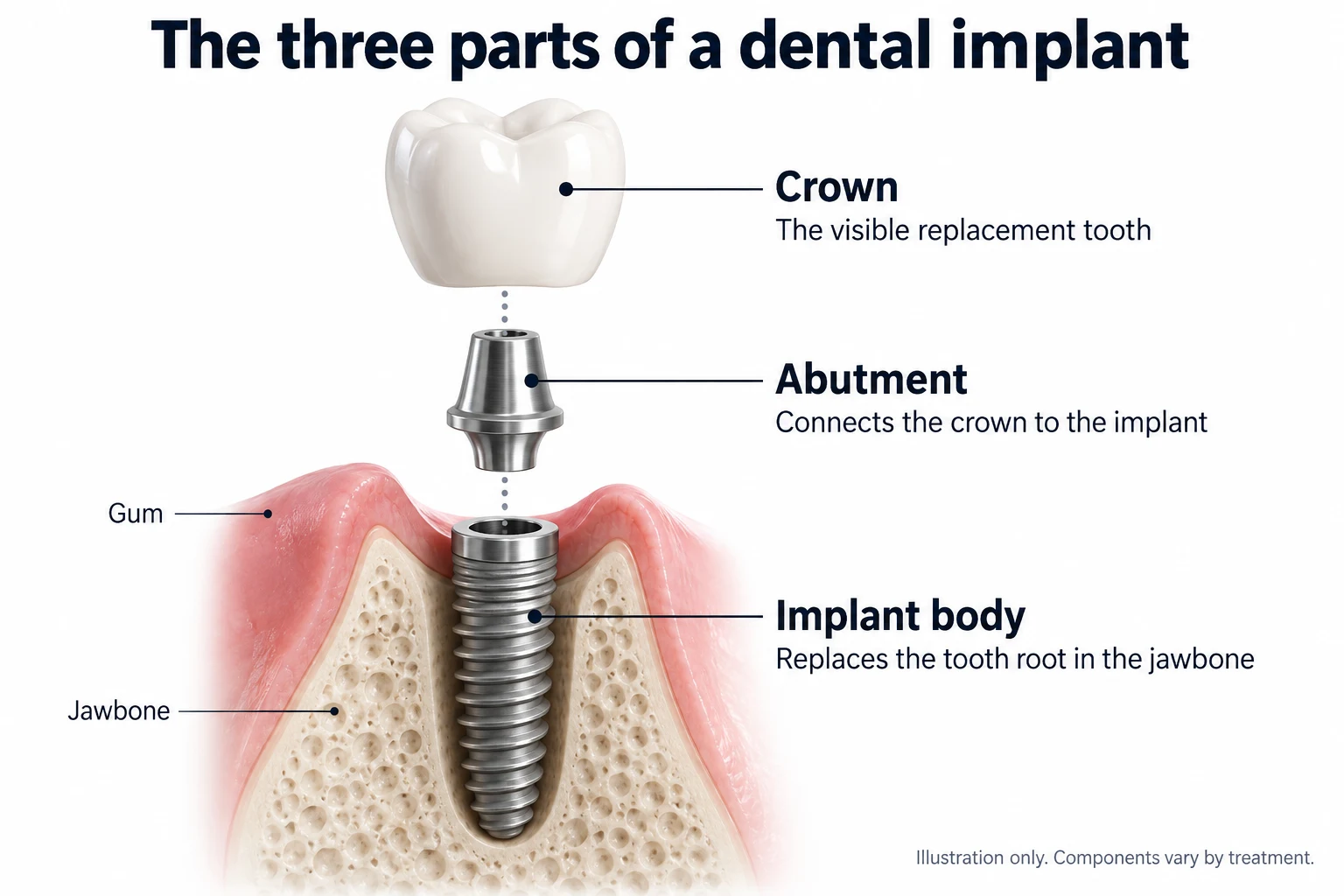 Exploded illustration of a dental implant: the crown above the abutment connector and the threaded implant body within the jawbone
