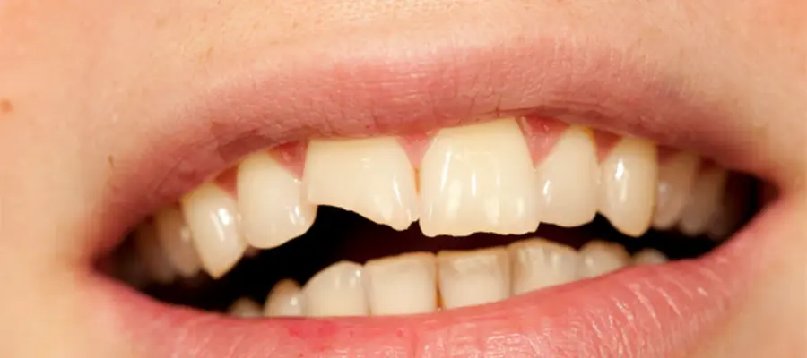 Traitement Des Dents Cassées