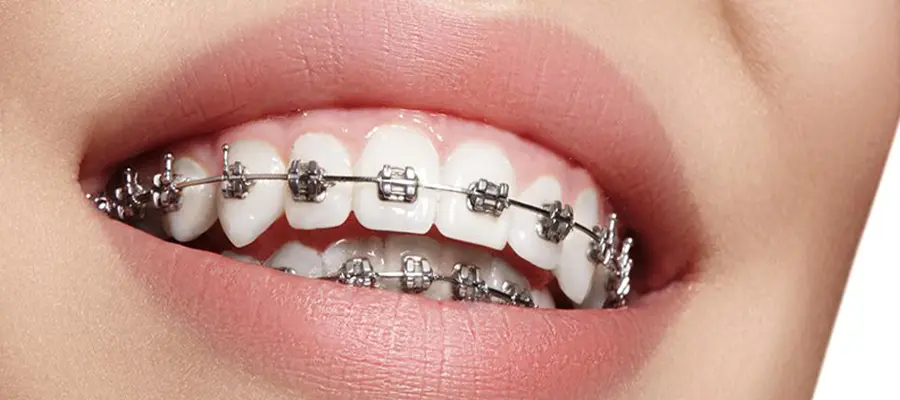 Orthodontique Traitement