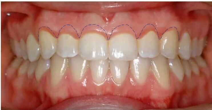 Gingivektomi gingivektomi nedir