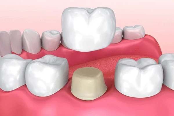 Porcelain Laminate Veneers