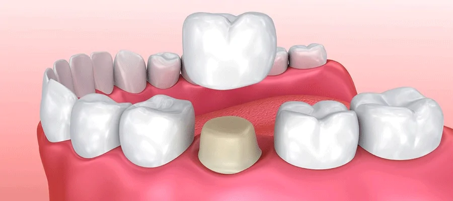 تاج البورسلين في تركيا 1 تاج البورسلين في تركيا