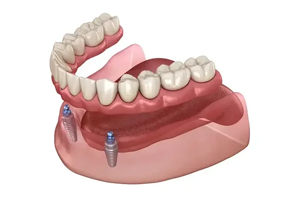 Implant Supported Prosthesis