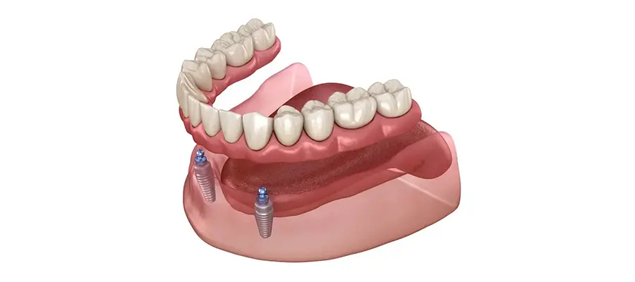 Prothèse Sur Implants