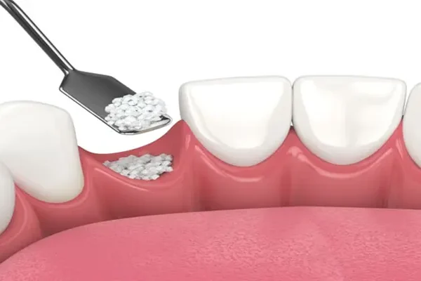 Костна аугментация