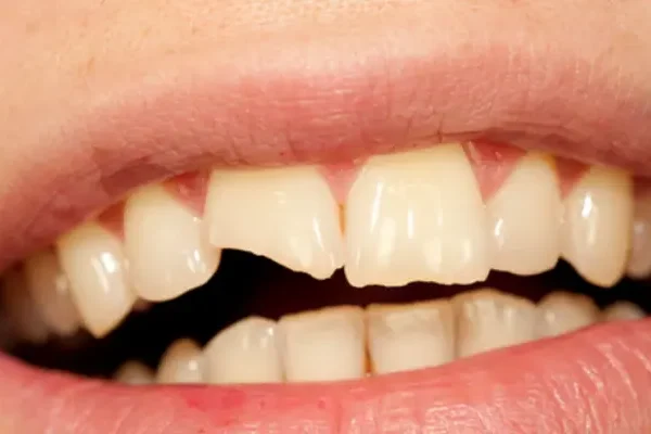 Broken Tooth Treatment