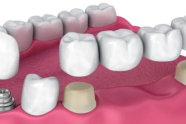 Dental Crowns and Bridges