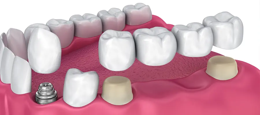 Коронна мостова протеза