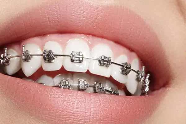 Orthodontic Treatment