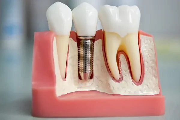 Dental Implants Turkey