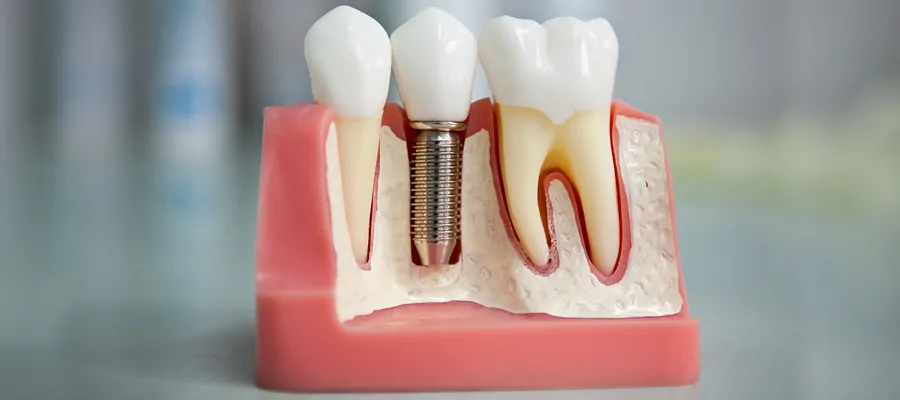 Зъбен имплант