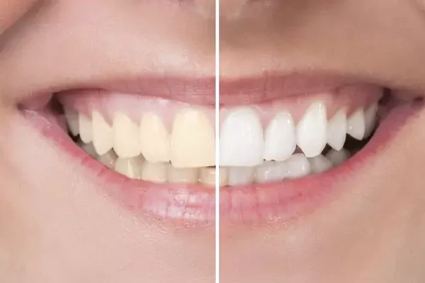 Teeth Whitening Turkey