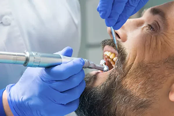 Почистване на зъбни камъни