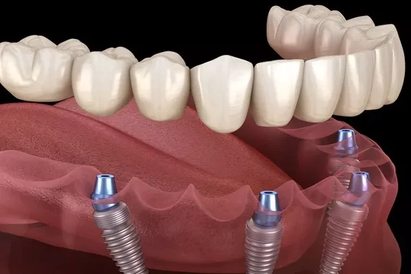 Implants Dentaires Bouche Complète