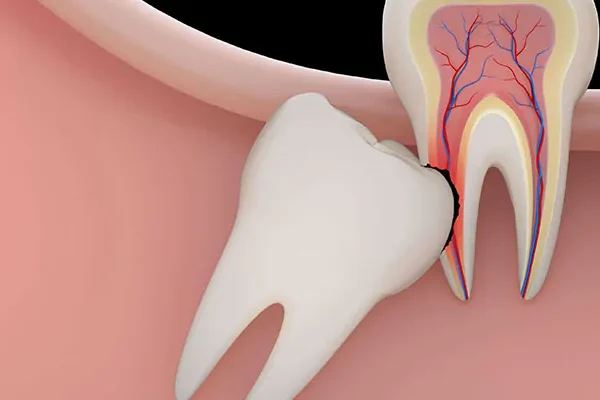 Dental Lesion Turkey