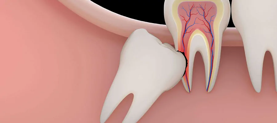 Лезия на зъбите 1 Лезия на зъбите