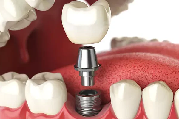 Имплантно лечение