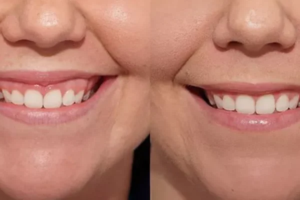 Ροζ Οδοντιατρική Αισθητική στην Τουρκία