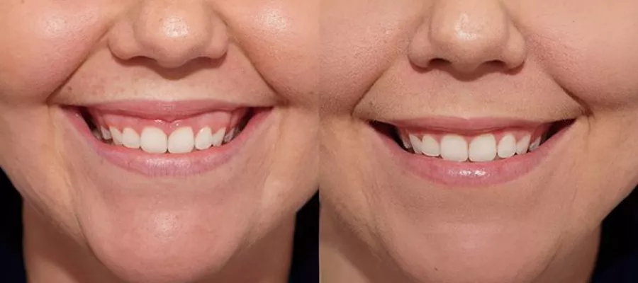 Эстетика розового зуба