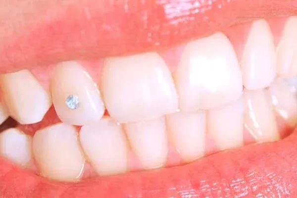 طب الأسنان التجميلي الوردي