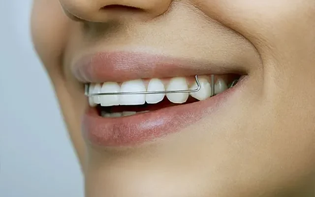 TMJ Splint 1 TMJ Splint