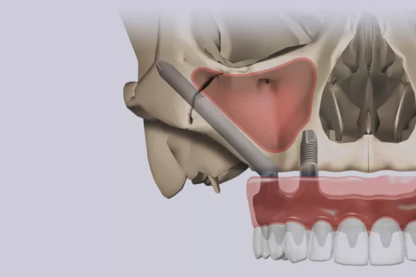 Zygomatic Implant Turkey